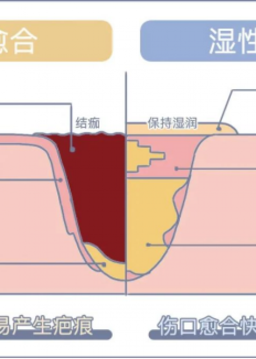 什么是“濕性愈合理論”